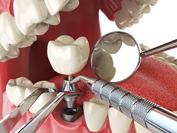 Best Emergency Root Canal Treatment in Stonegate, CO